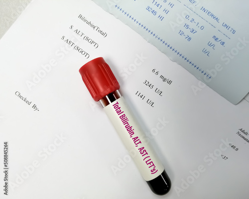 Blood sample for ALT, AST and Total Bilirubin test with abnormal report. LFTs or Liver Function Tests. photo