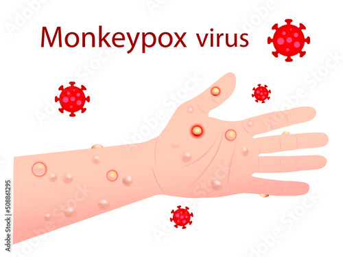 Monkeypox virus that can infect human, Monkey pox. Vector illustration