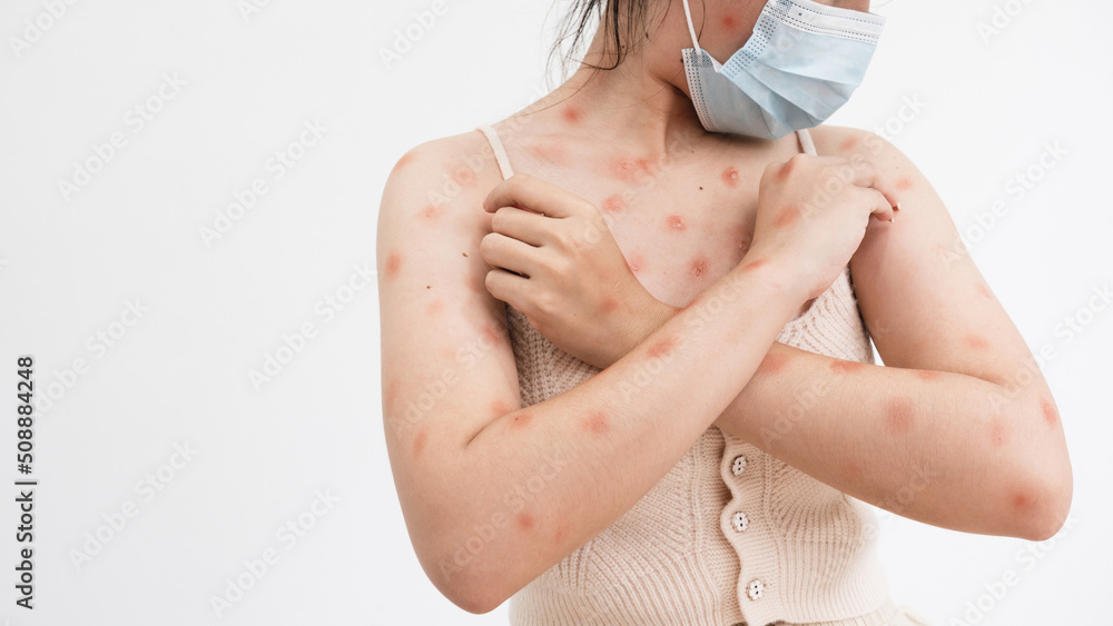 Concept of monkeypox epidemic, white woman Wearing a medical mask, skin