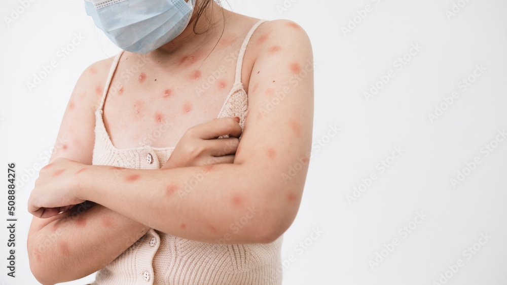 Concept of monkeypox epidemic, white woman Wearing a medical mask, skin ...