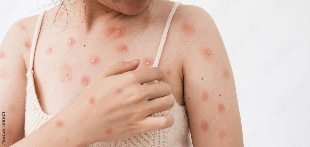 monkeypox-Skin erythema-pustules-boils-itching-Psoriasis-Causes-Symptoms-Diagnosis-Treatment-Best Homeopathic doctor-Dr. Qaisar Ahmed-Al Haytham clinic-Risalpur-Pakistan