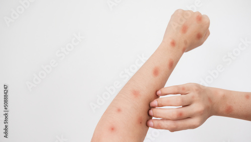 Concept of epidemic of monkey pox virus, white woman scratching skin, red rash, pustules and abscess, itching after being infected with monkeypox virus. photo