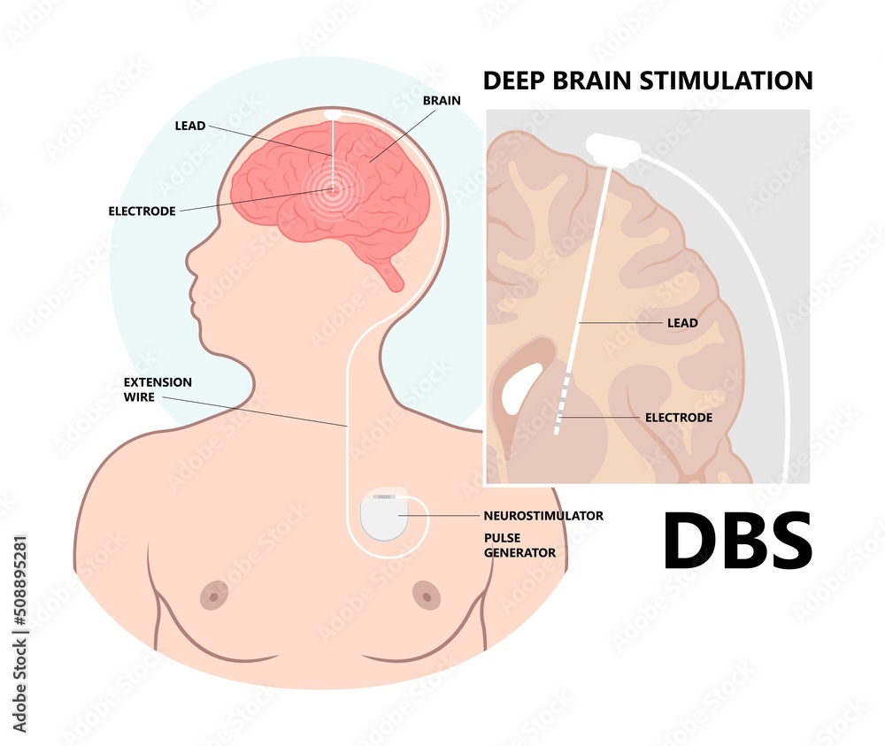 Deep brain stimulation or DBS treat Parkinson's disease PD and TMS condition major neural