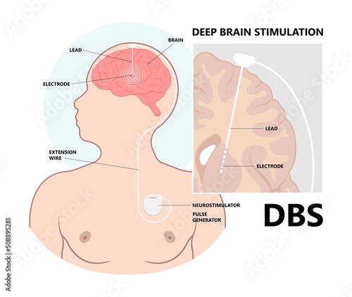 Deep brain stimulation or DBS treat Parkinson's disease PD and TMS condition major neural stimulator pulse neurological wave implanted Motor bipolar photo
