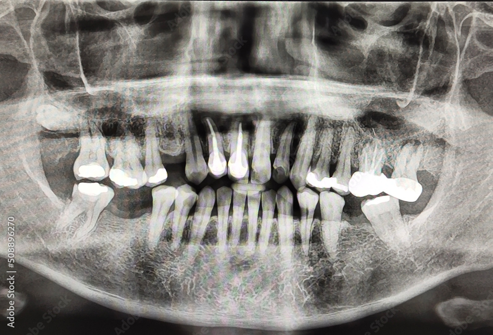 Zdjęcie Stock panoramic radiograph skull full mouth xray human