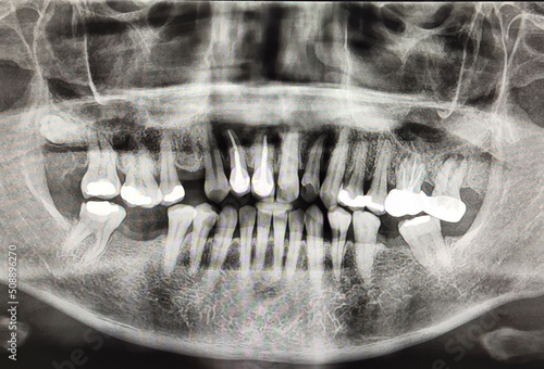 panoramic radiograph skull full mouth x-ray human disease oral surgery dentistry teeth patient care. CT scan of the jaw orthopantomogram root tooth film X-ray dental pin. Science healthy tooth concept