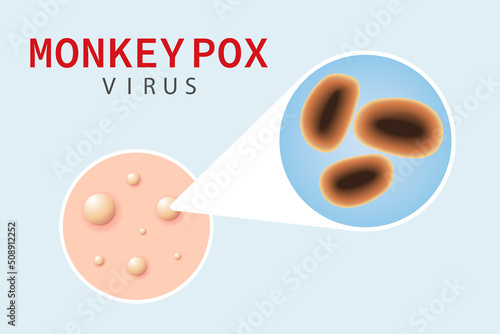  Monkeypox virus on skin. Diagram of a virion cell under a microscope. Vector illustration