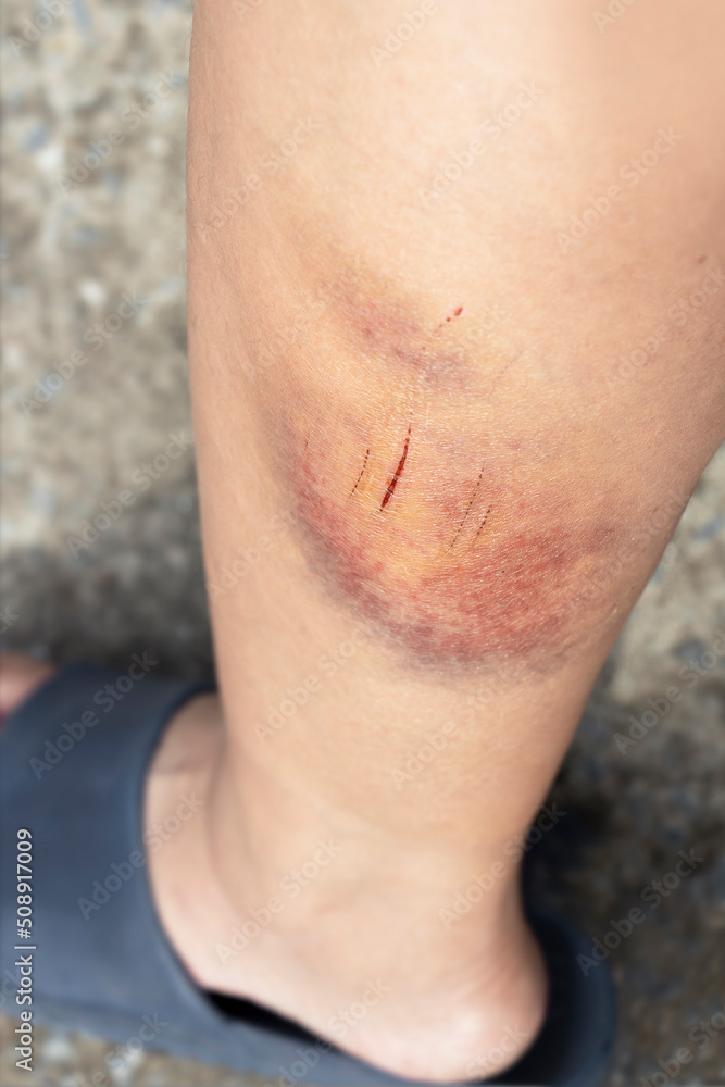 The bruises and wound form scabs on legs. The wound happen during woman Injuries from accident falling down on road. The bruises and wound form scabs on legs. The wound happen during woman Injuries from accident falling down on road.
