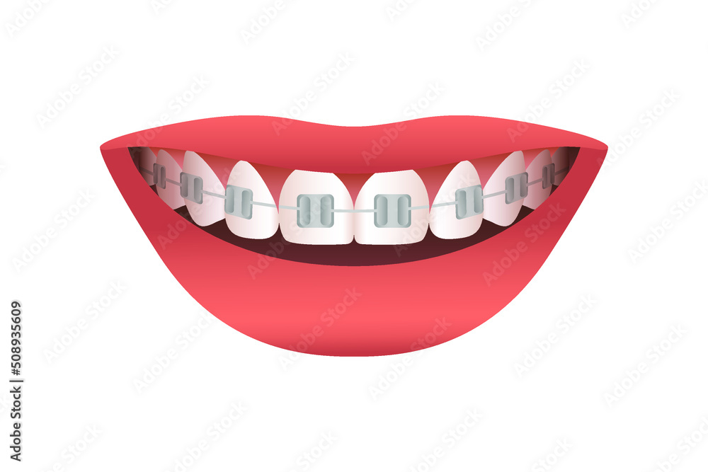 Smile with braces isolated on white background. Vector illustration Smile with braces isolated on white background. Vector illustration