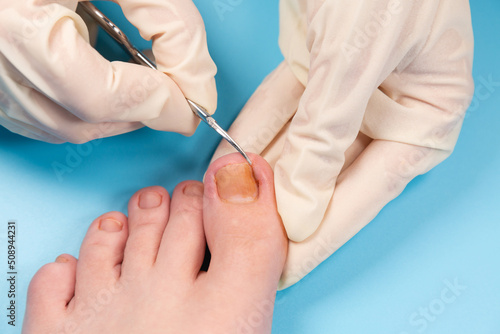 doctor cuts the injured toenail. Hands in rubber gloves touch injured toenail in clinic. Diagnosis, treatment of mycosis of feet. Podiatrist treating ingrown toenail. Inflammation of the toes photo