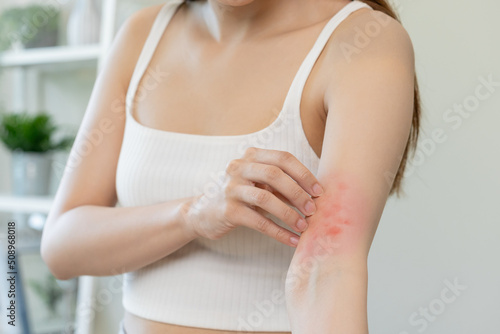Dermatology asian young woman, girl allergy, allergic reaction from atopic, insect bites on her arm, hand in scratching itchy, itch red spot or rash of skin. Healthcare, treatment of beauty. photo