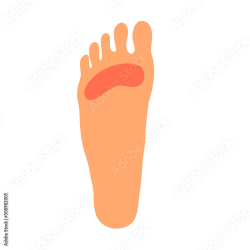 A woman leg with a sore callus. Transverse flat feet. Orthopedic disease. Foot health problems. Vector illustration isolated on white background