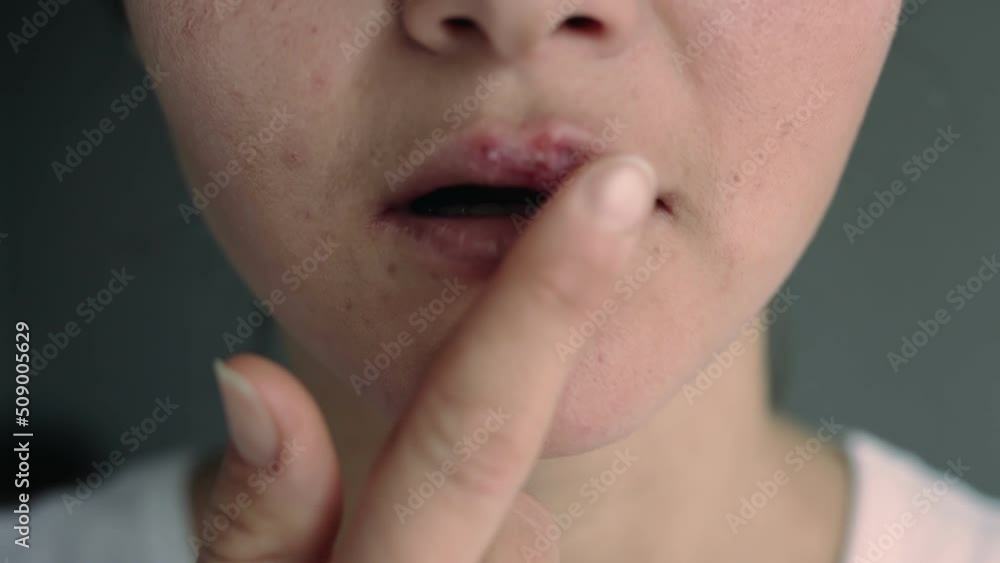 Young woman with lips affected by herpes. Applying a healing ointment. Young woman with lips affected by herpes. Applying a healing ointment.