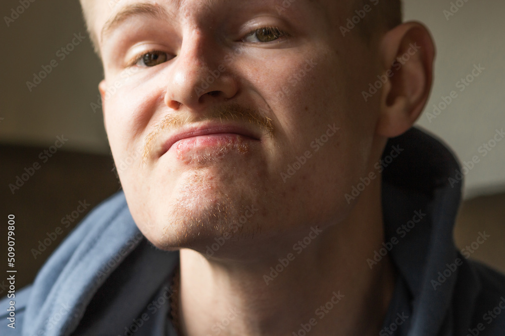 Close up portrait of man's lips infected herpes virus. Painful emotionless look. Skin care and daily hygiene. Close up portrait of man's lips infected herpes virus. Painful emotionless look. Skin care and daily hygiene.