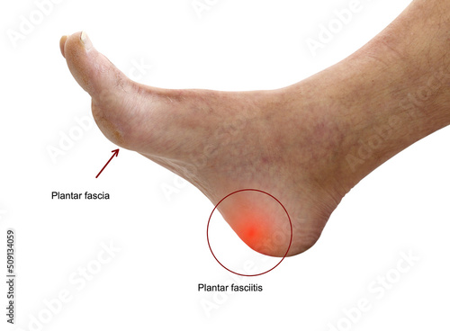 Close up human heel with red spots point at planet fascia and plantar fasciitis at the bottom of foot common or heel pain in runner. Foot disease chart use for medical concept.	 photo