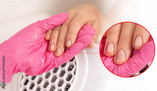Manicurist in pink medical gloves holds a client's hand with dirty, sore nails. Close-up. The concept of problems and fungal nail damage photo