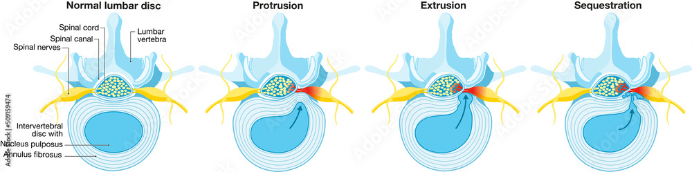 Normal lumbar disc. Bulge. Protrusion. Extrusion. Sequestration ...