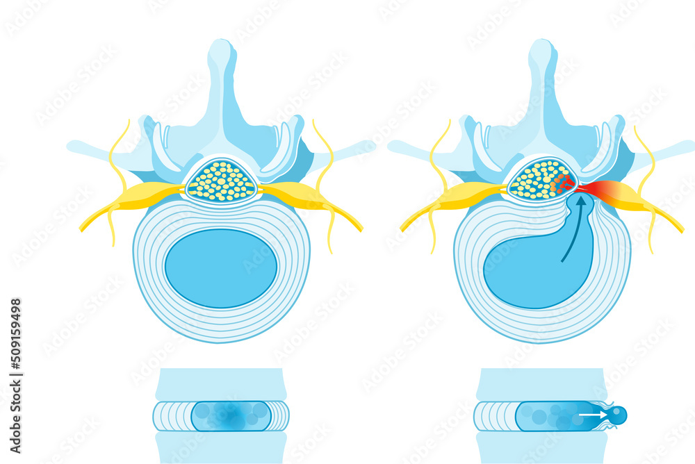 Normal disc. Bulge. Protrusion. Extrusion. Sequestration. Herniated
