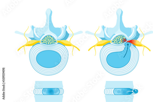 Normal disc. Bulge. Protrusion. Extrusion. Sequestration. Herniated disc schema. Blue design. Labeled illustration photo
