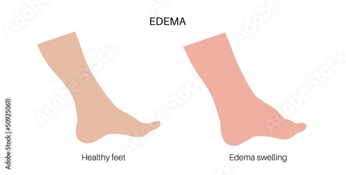 Edema of feet