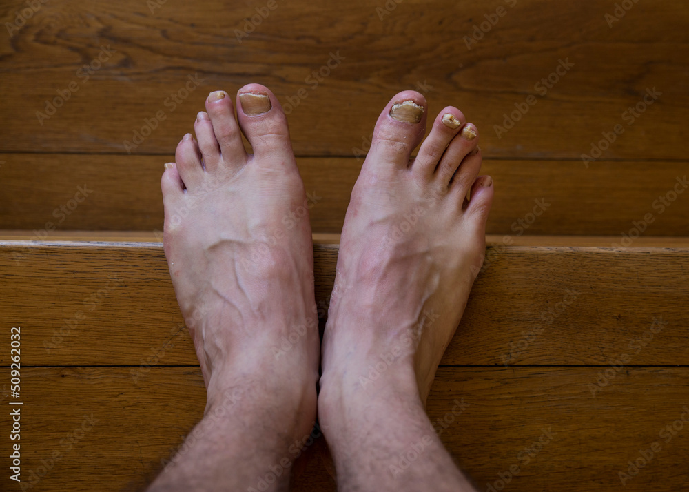 Fototapeta premium Onychomycosis with fungal nail infection two feet