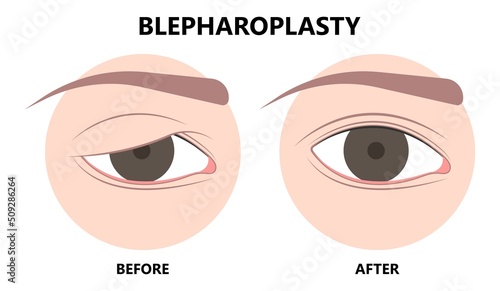 Before and after of drooping eyelid lift surgery or blepharoplasty surgical procedure to treat removes excess skin