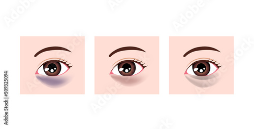 Color types of dark circles under eyes. Vector illustration