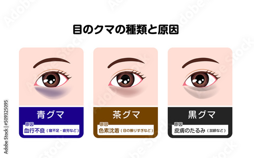 目のくま（眼のクマ) の種類と原因 ベクターイラスト