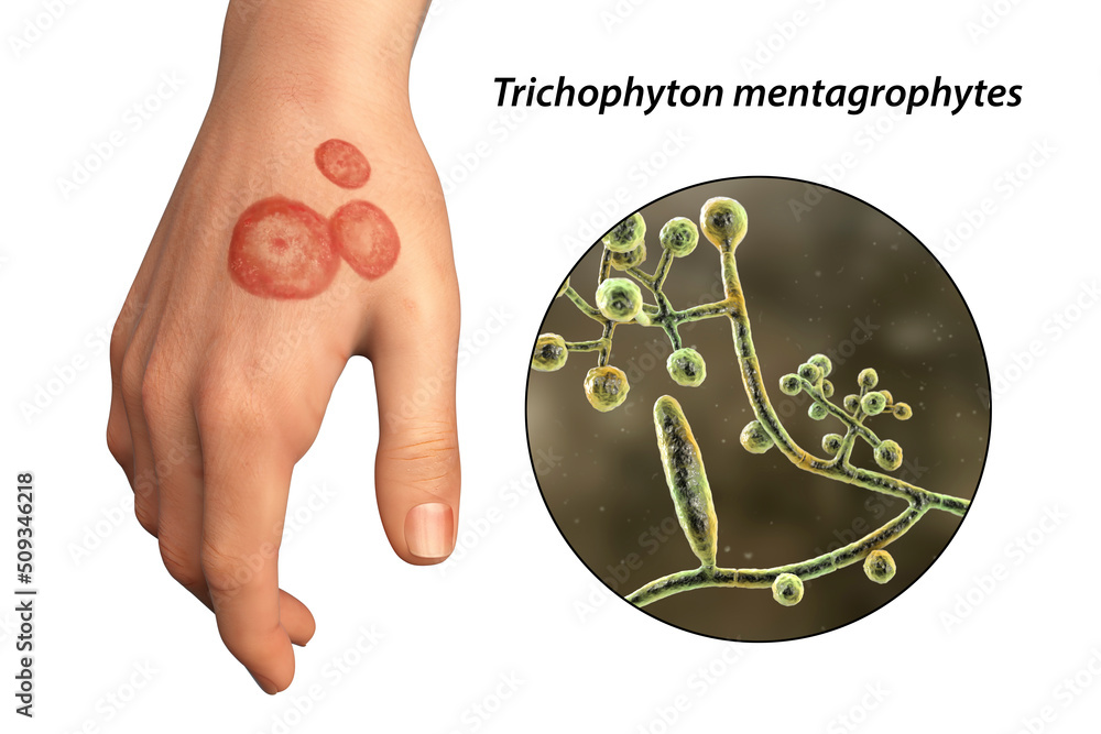 Hand fungal infection, tinea manuum, 3D illustration Stock