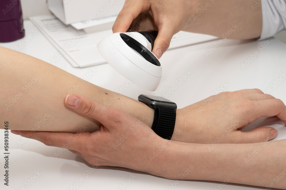 Fototapeta premium Close-up of a dermatologist examining a mole on a female patient's arm using a magnifying glass at a table in a clinic