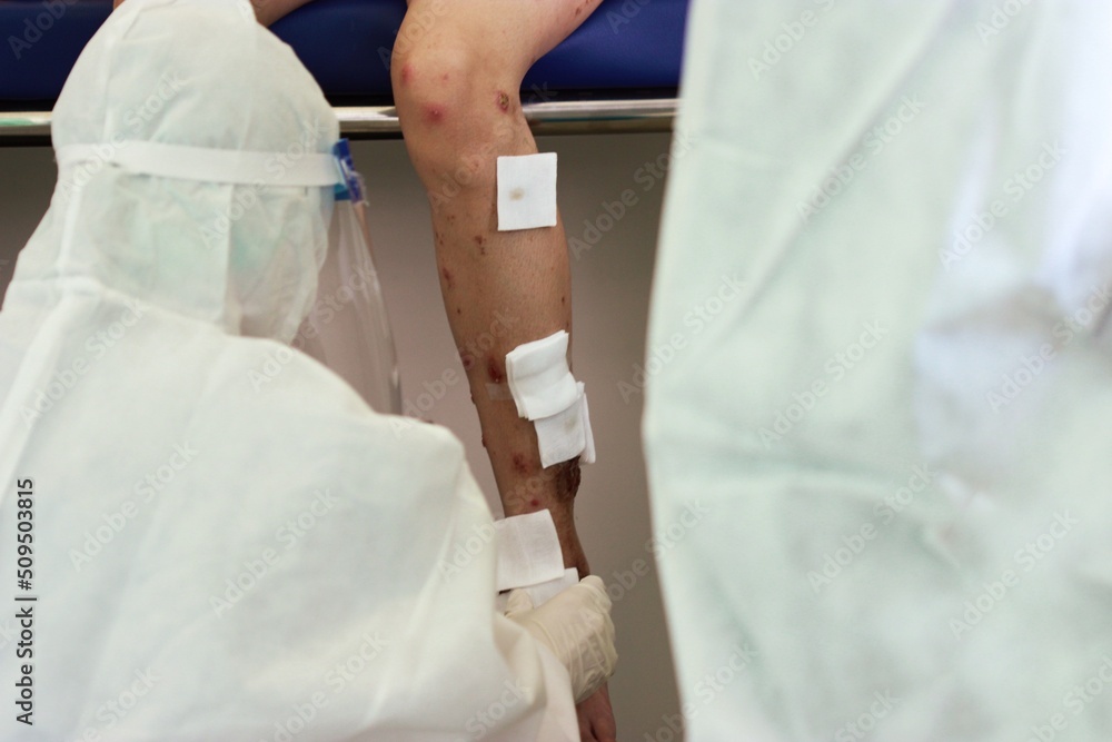 A nurse wearing medical gloves dressing wound of multiple discrete well