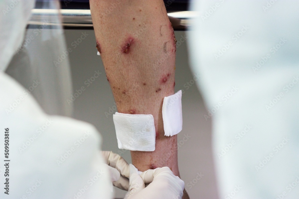 A nurse wearing medical gloves dressing wound of multiple discrete well
