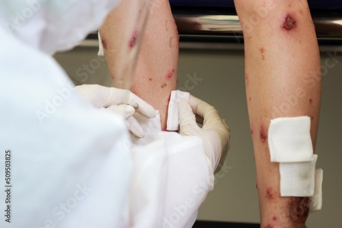 A nurse wearing medical gloves dressing wound of multiple discrete well defined scaly erythematous pustules and plauques with crusted and serum oozing at both legs with sterile gauze. Chicken pox.
