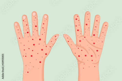 Hand of a patient with monkeypox infection, Monkeypox is a zoonotic virus from Poxviridae family, causes monkeypox, a pox-like disease