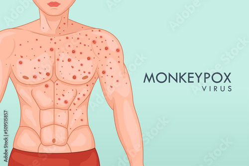 Male body affected by blistering rash because of Monkeypox or other viral infection