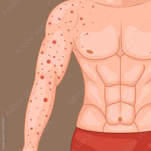 Male arms affected by blistering rash because of Monkeypox or other viral infection