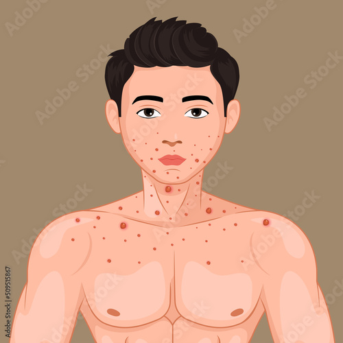 Male face affected by blistering rash because of Monkeypox or other viral infection