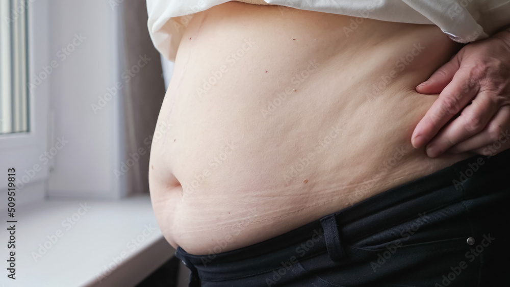 Overweight aged woman checks fat on belly. Woman compresses skin on