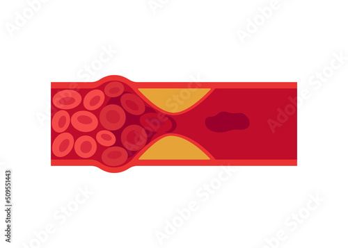Blood clot, thrombus in vein or artery. Deep vein thrombosis DVT or arterial clot, artery and vein cholesterol sick, abnormally of blood vascular flow. Blocked circulation in blood vessel. Vector