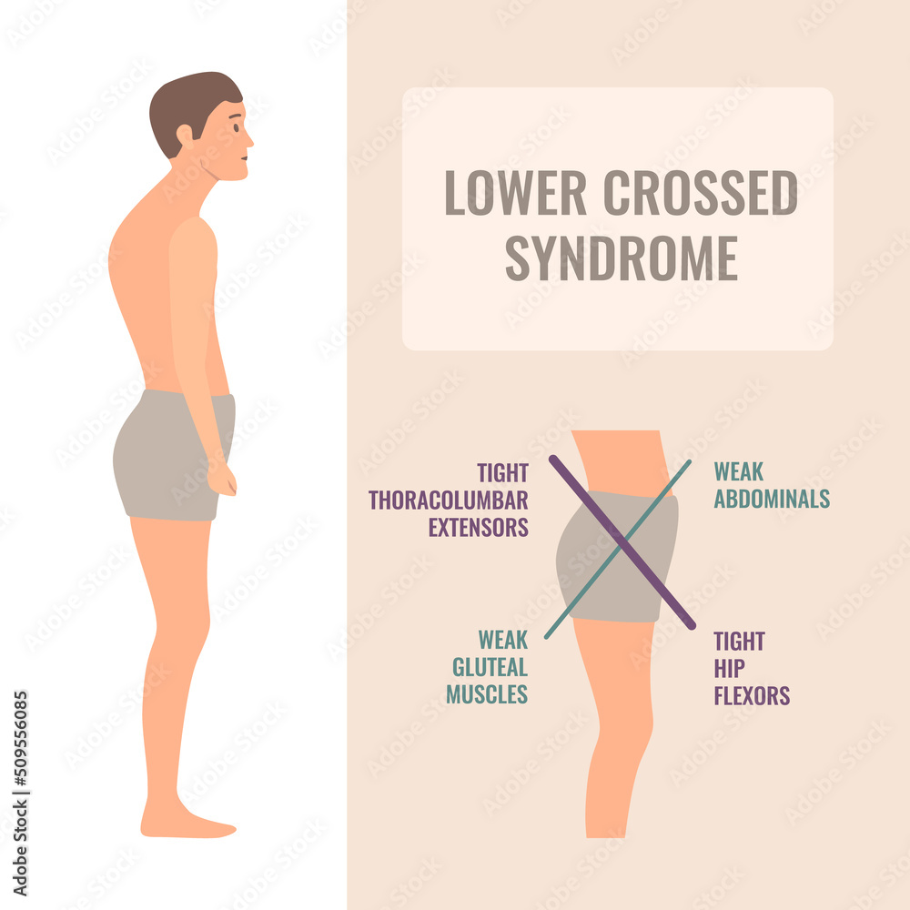 Photo & Art Print Lower crossed syndrome medical diagram, art4stock