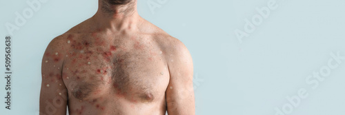 Male chest affected by blistering rash because of monkeypox or other viral infection on white background photo
