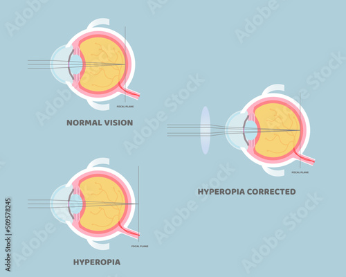 eyeball anatomy, internal organs body part nervous system, hyperopia concept, vector illustration cartoon flat design clip art