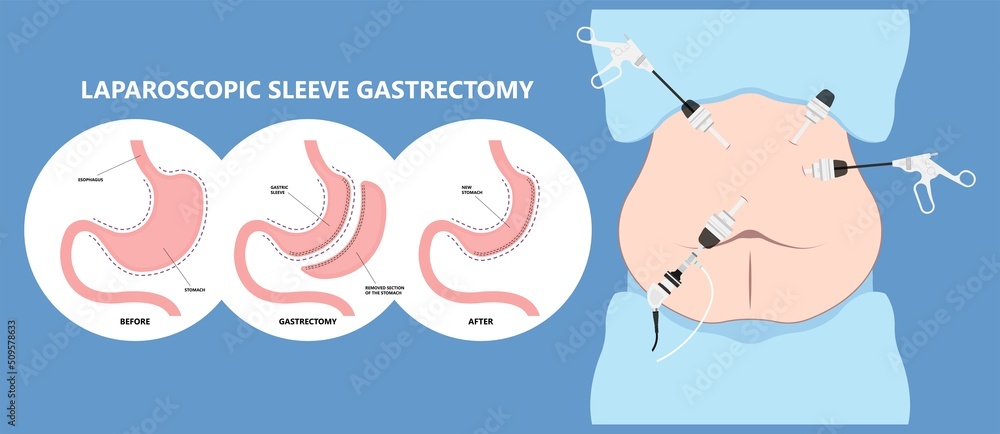 Gastric bypass surgery and Band roux en y procedure endoscopy weight loss hiatal hernia diet food full body mass index or BMI reflux GERD eat obese clinic tummy tuck small lap sleep apnea high blood Gastric bypass surgery and Band roux en y procedure endoscopy weight loss hiatal hernia diet food full body mass index or BMI reflux GERD eat obese clinic tummy tuck small lap sleep apnea high blood