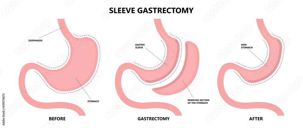 Fototapeta premium Gastric bypass surgery and Band roux en y procedure endoscopy weight loss hiatal hernia diet food full body mass index or BMI reflux GERD eat obese clinic tummy tuck small lap sleep apnea high blood