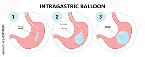 Gastric bypass surgery and Band roux en y procedure endoscopy weight loss hiatal hernia diet food full body mass index or BMI reflux GERD eat obese clinic tummy tuck small lap sleep apnea high blood