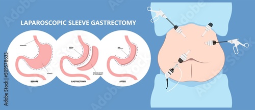 Gastric bypass surgery and Band roux en y procedure endoscopy weight loss hiatal hernia diet food full body mass index or BMI reflux GERD eat obese clinic tummy tuck small lap sleep apnea high blood