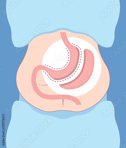 Gastric bypass surgery and Band roux en y procedure endoscopy weight loss hiatal hernia diet food full body mass index or BMI reflux GERD eat obese clinic tummy tuck small lap sleep apnea high blood