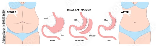 Gastric bypass surgery and Band roux en y procedure endoscopy weight loss hiatal hernia diet food full body mass index or BMI reflux GERD eat obese clinic tummy tuck small lap sleep apnea high blood