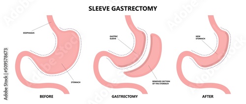 Gastric bypass surgery and Band roux en y procedure endoscopy weight loss hiatal hernia diet food full body mass index or BMI reflux GERD eat obese clinic tummy tuck small lap sleep apnea high blood