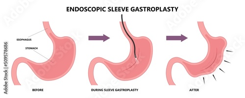Gastric bypass surgery and Band roux en y procedure endoscopy weight loss hiatal hernia diet food full body mass index or BMI reflux GERD eat obese clinic tummy tuck small lap sleep apnea high blood
